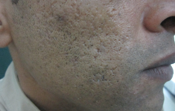 Enlarged Pores After 3 Treatments